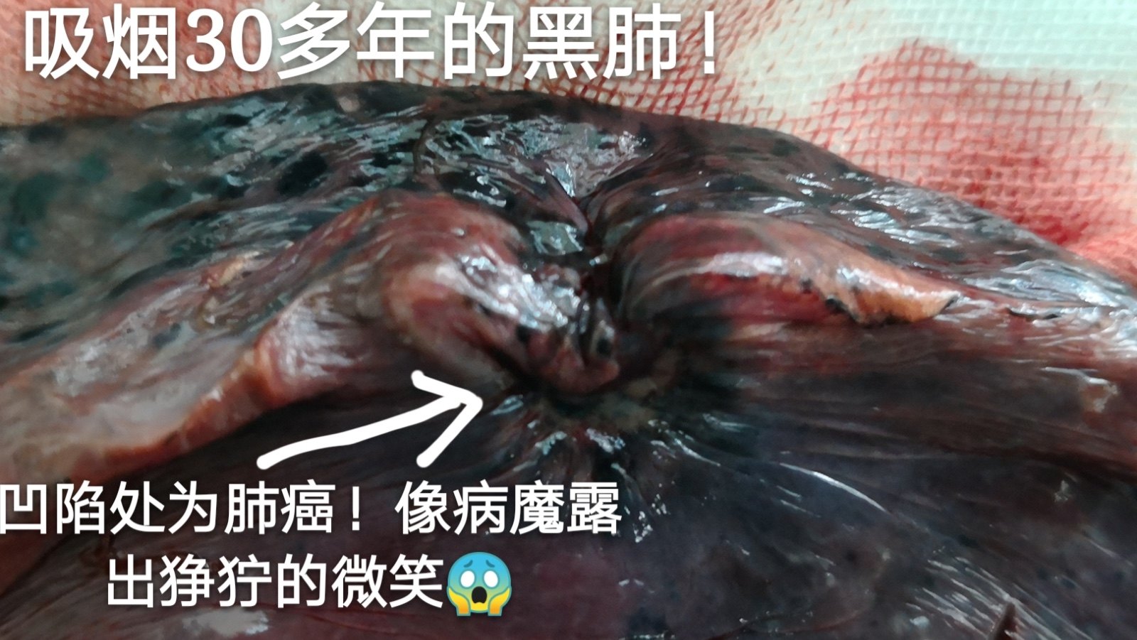 为郑州中院点赞大家看看吸烟者的肺是这样的