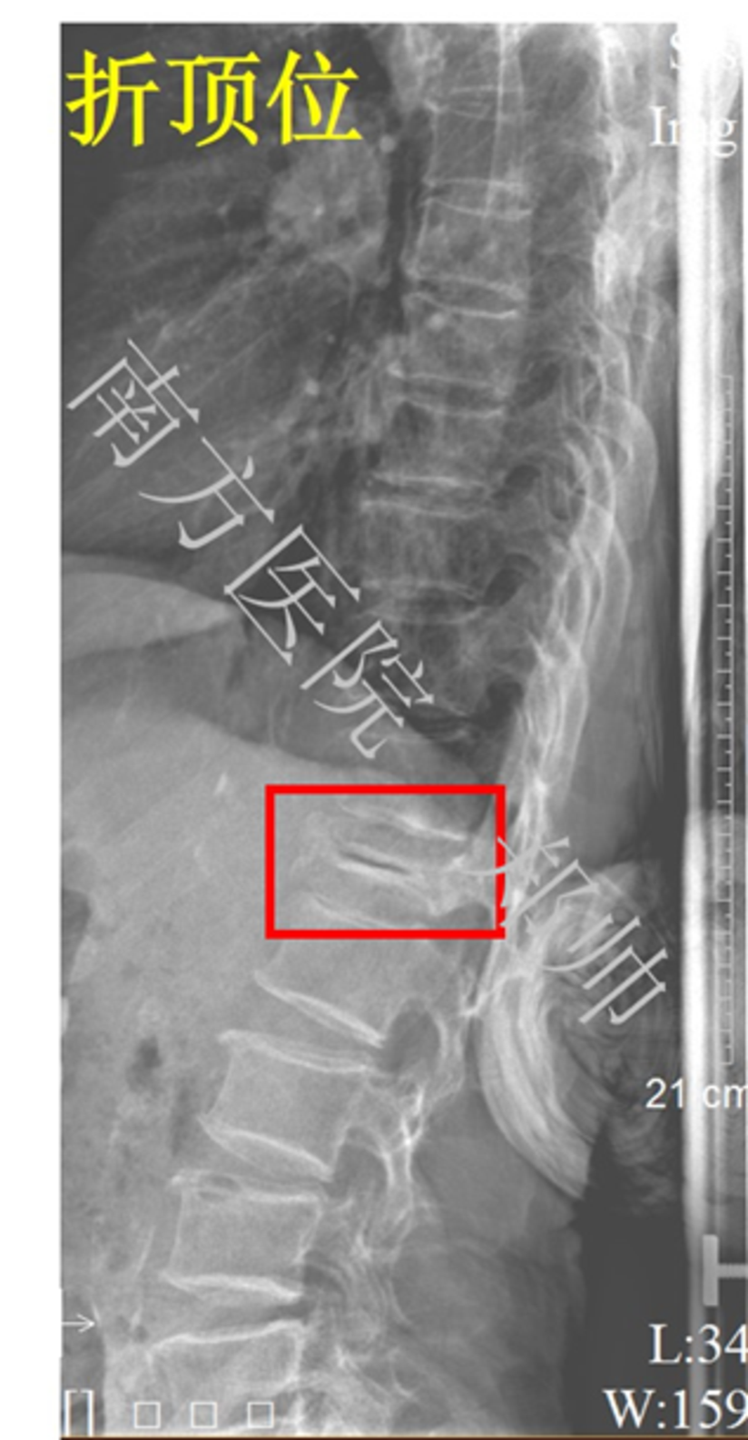 什么是kummell病 陈旧性椎体骨折骨 附图 健康号 微医