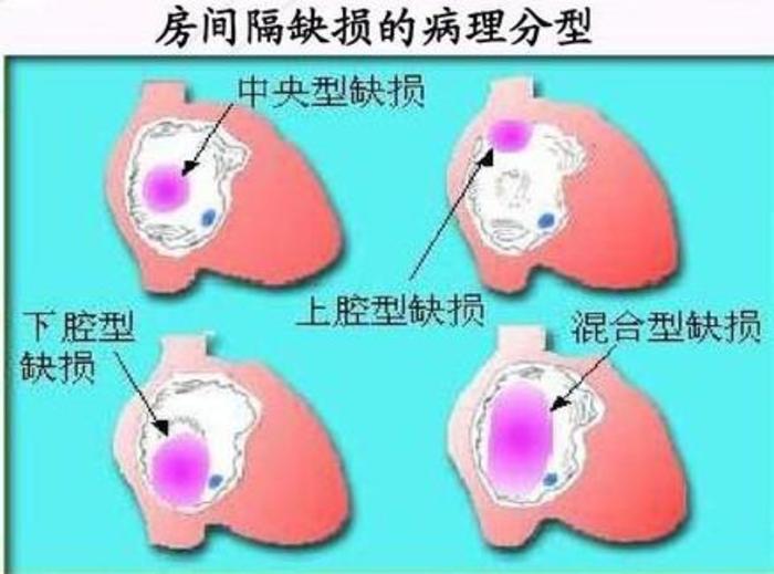 房间隔缺损,先天性心脏病系列之一