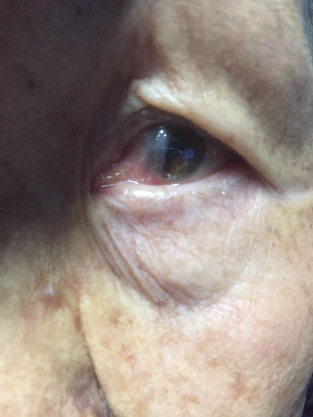 一上来就说她奶奶得了白内障,一个眼睛0