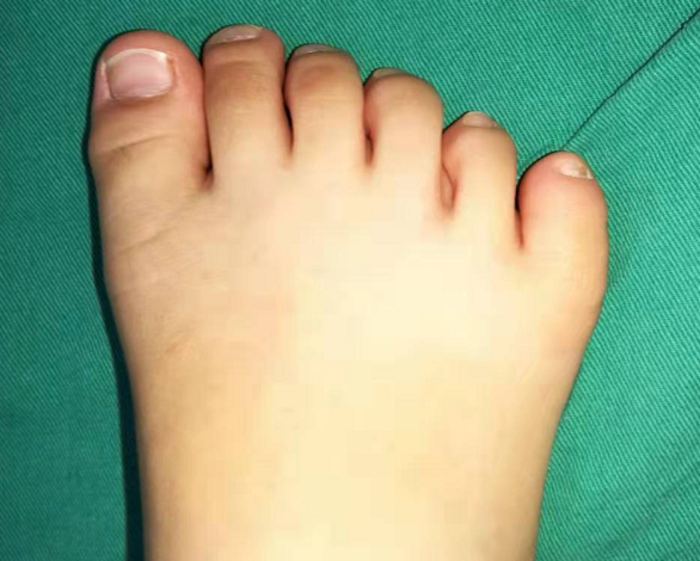 孩子有6个脚趾头影响大吗