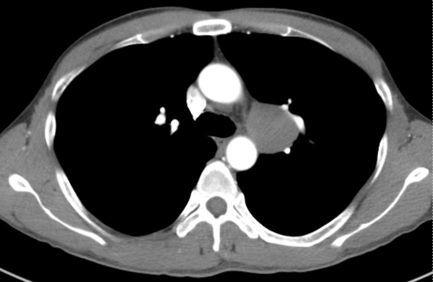 前纵隔结节前纵隔肿块胸腺囊肿thymiccyst和胸腺瘤如何区别需要手术吗