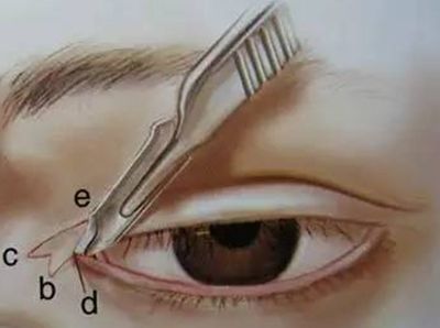双眼皮+开眼角后为什么眼角会有疤痕增生?