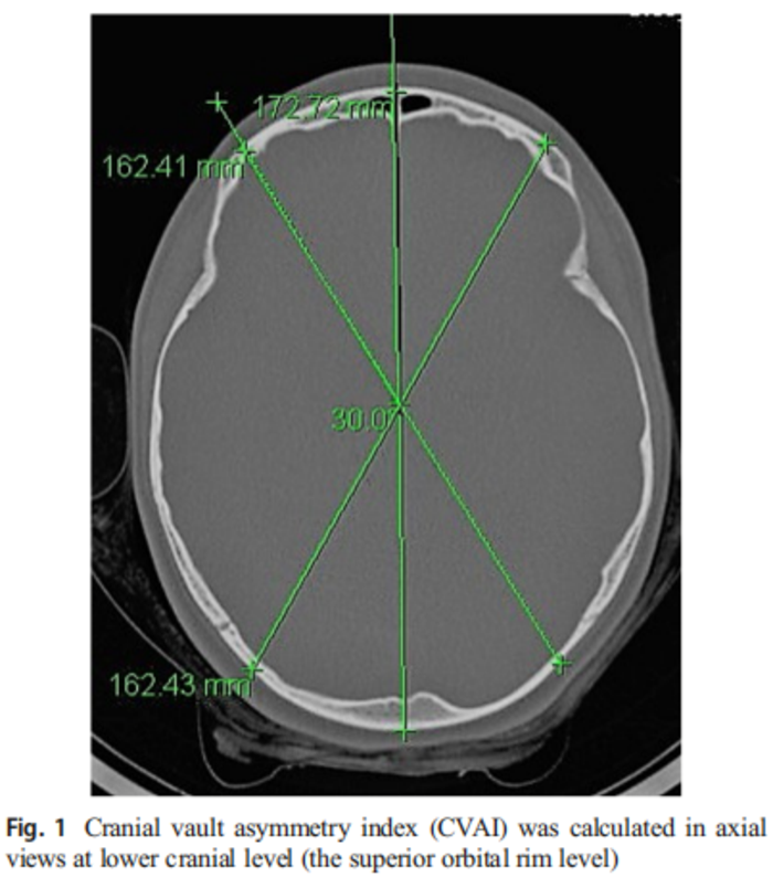 婴幼儿及青少年姿势性斜头畸形的患病率和严重程度 - 微医(挂号网)