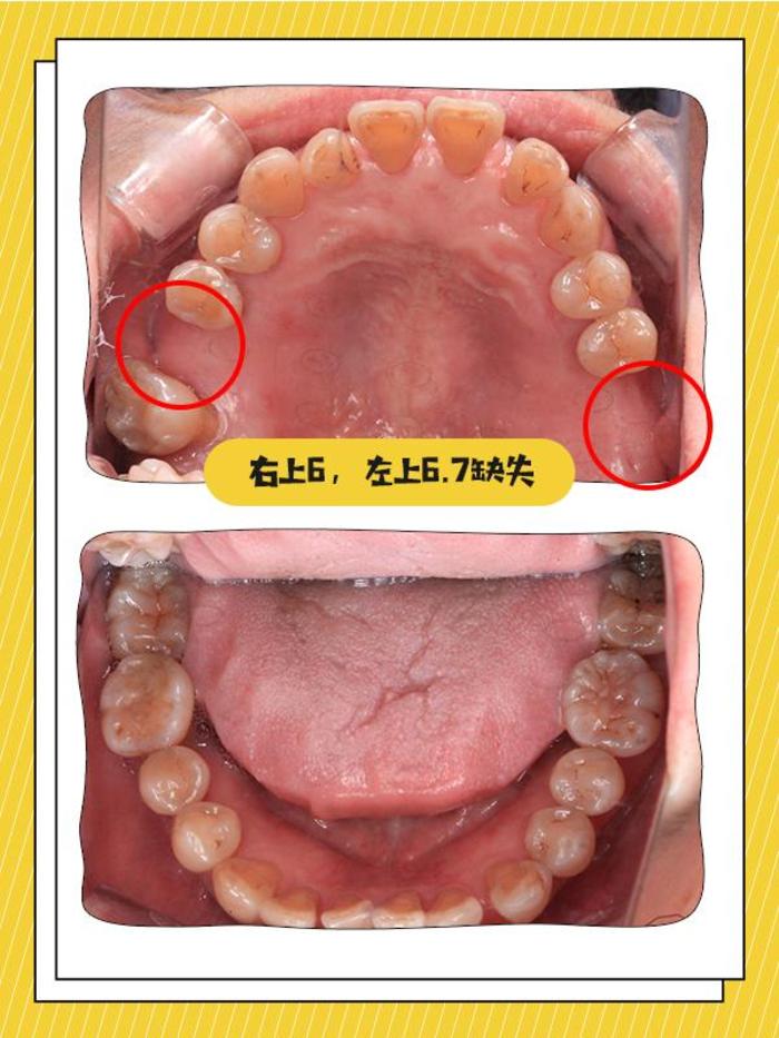 磨牙缺失真的要修复吗