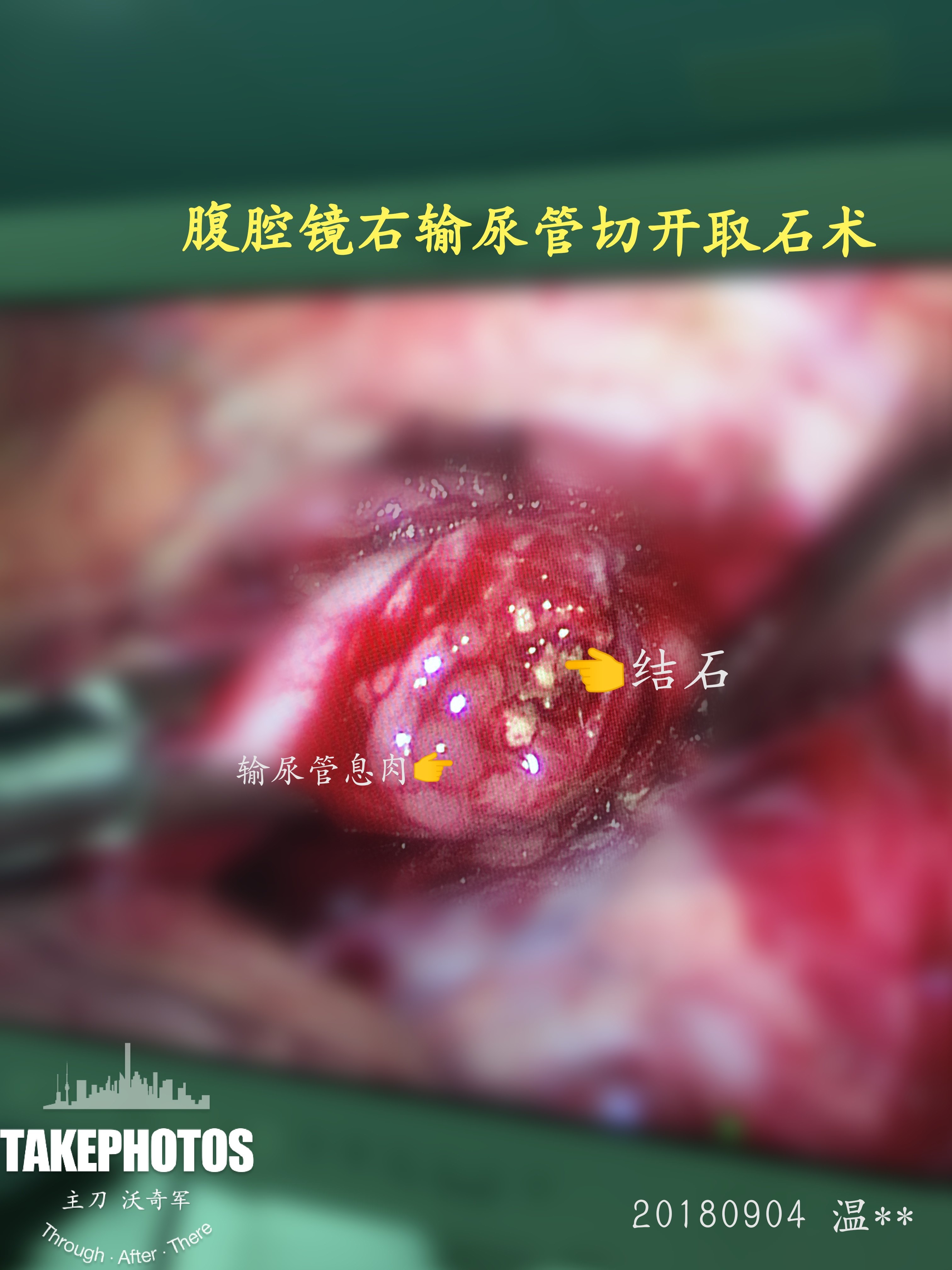 很多医院采用输尿管镜和经皮肾镜的手术方式治疗输尿管结石 ,但如果