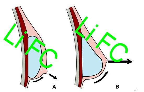 乳房下垂二乳房假体植入矫正乳房下垂