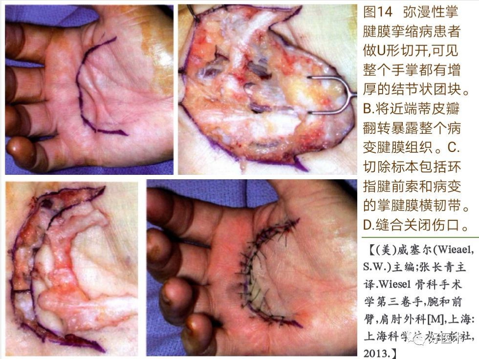 掌腱膜挛缩症的诊治技巧系统详解