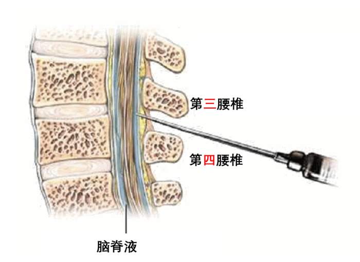 民医生说为什么做腰椎穿刺腰穿