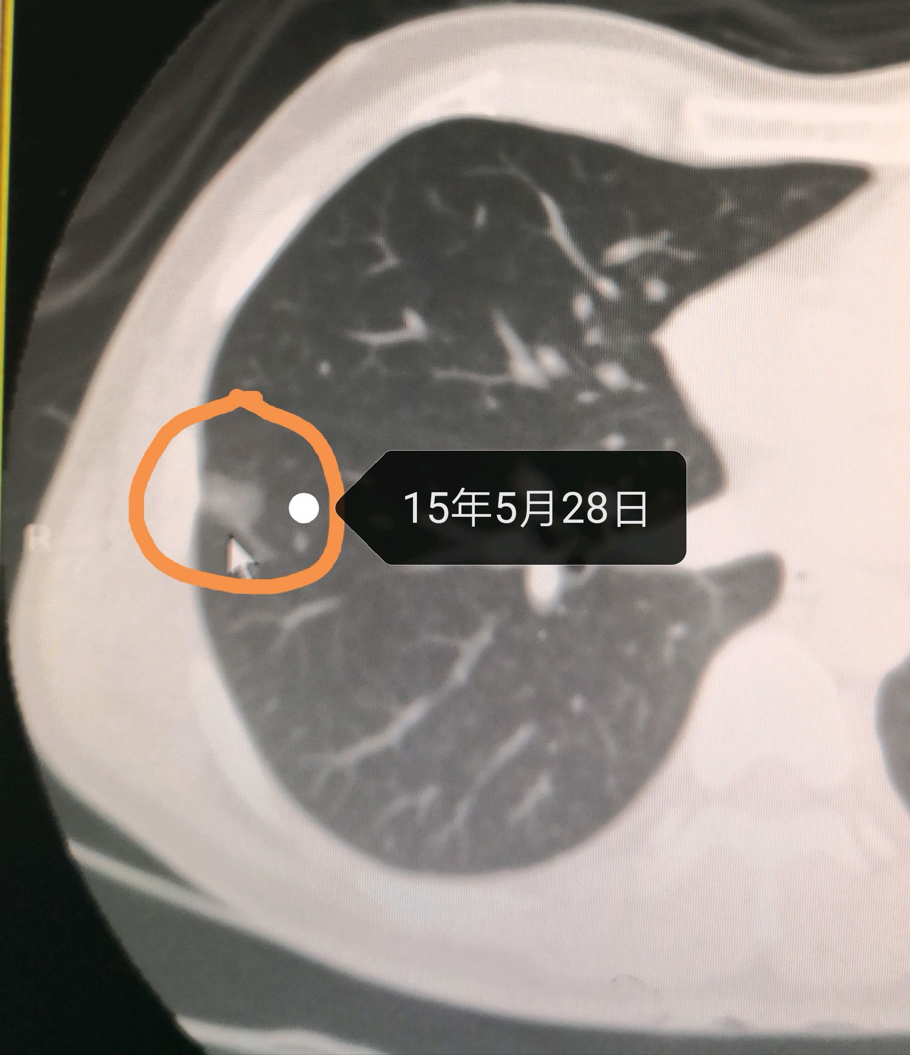 看肺小结节如何一步一步变成肺癌