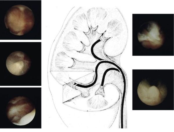 输尿管软镜碎石术让肾脏不再受伤