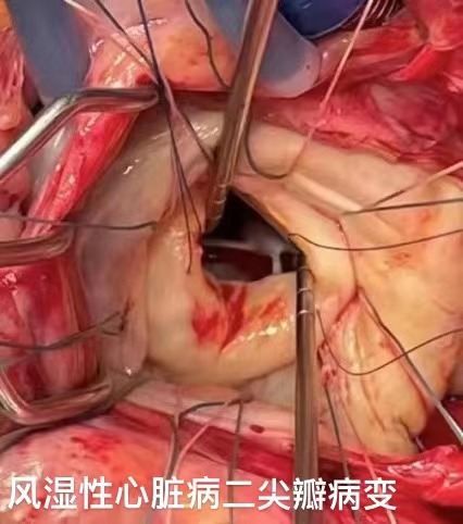 心脏瓣膜病的外科治疗修复和置换之争v