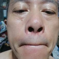 0612男刘建立鼻子周围毛细血管发红是什么原因
