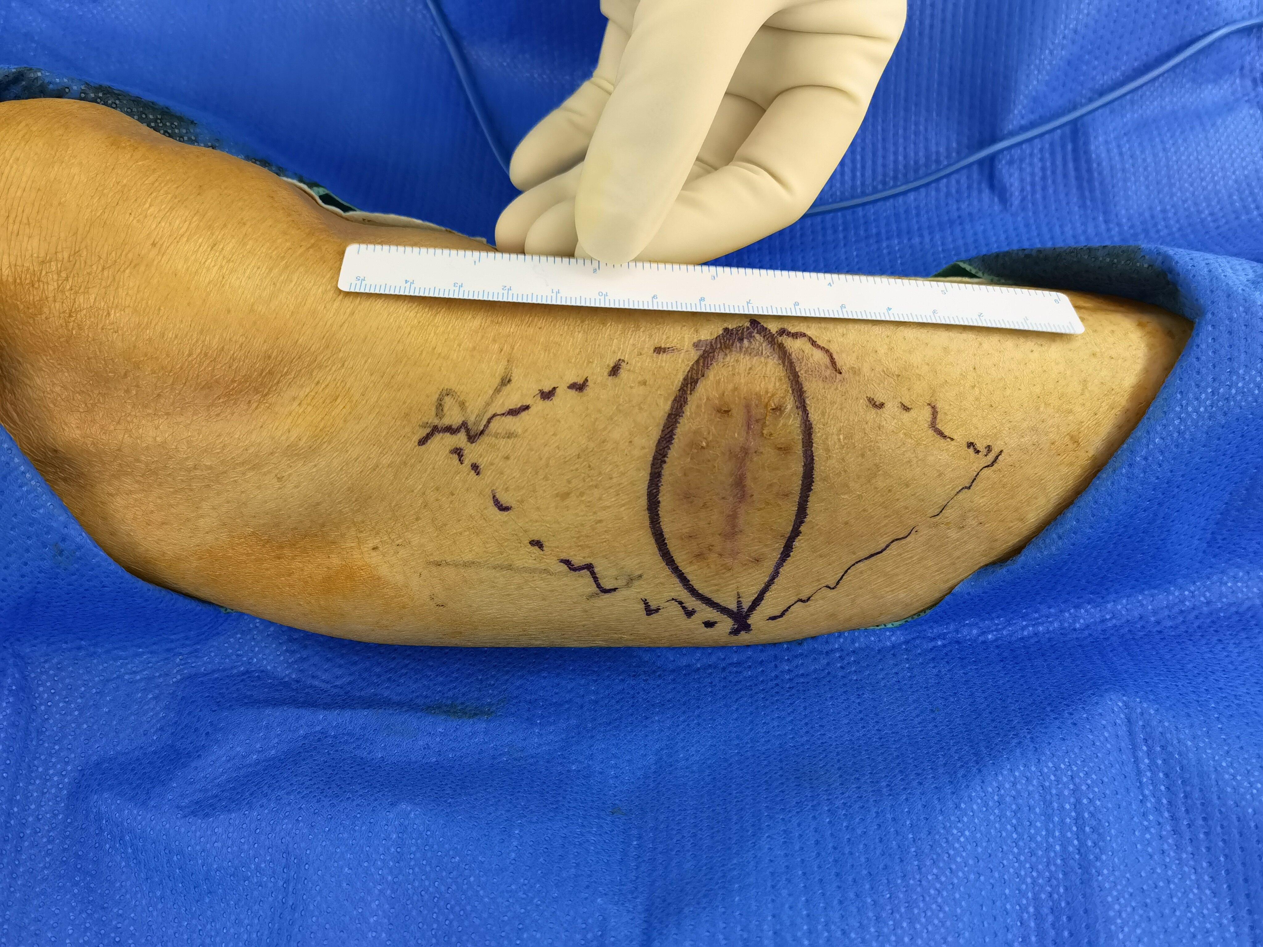 【典型病例】推进皮瓣在软组织肉瘤二次扩大切除中的应用