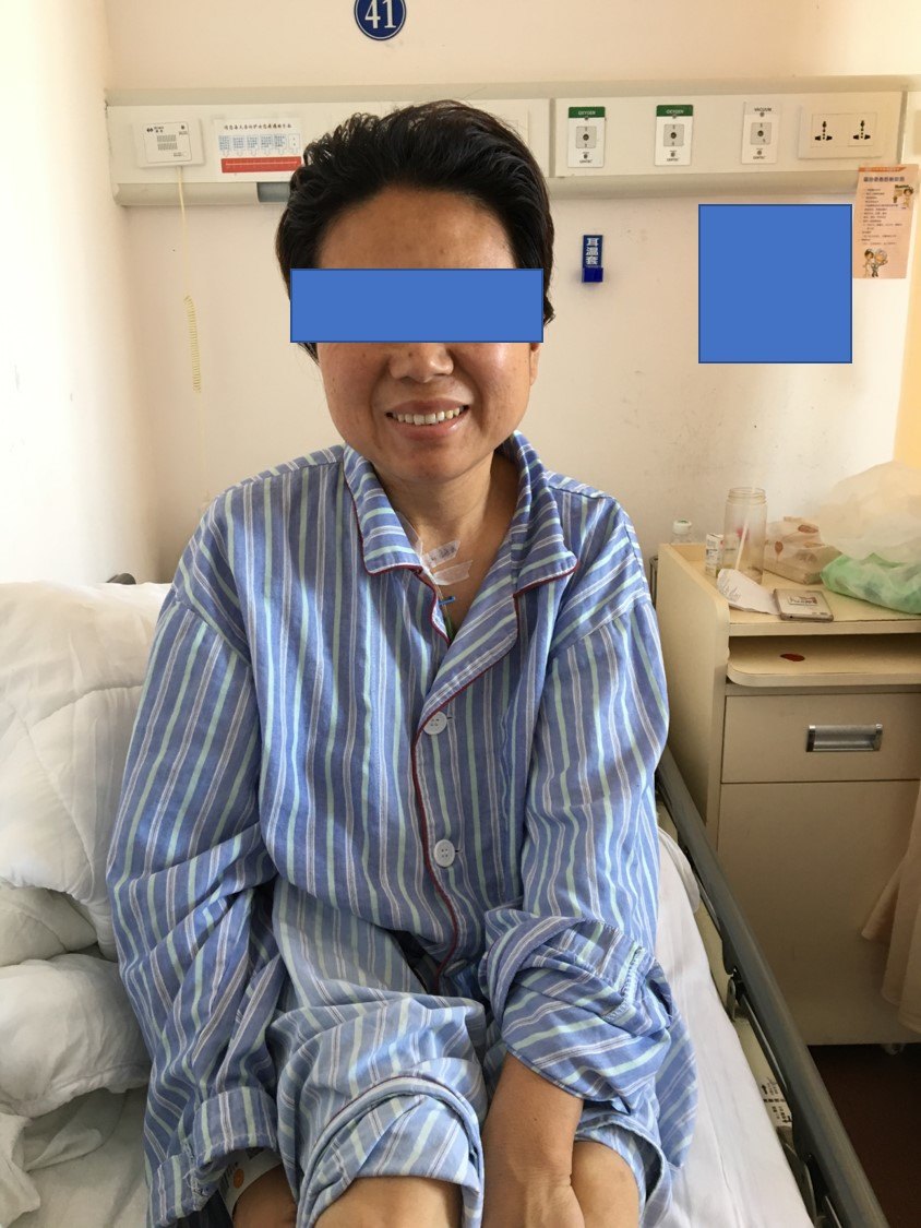 经鼻微创手术治疗泌乳素型垂体瘤 - 微医(挂号网)