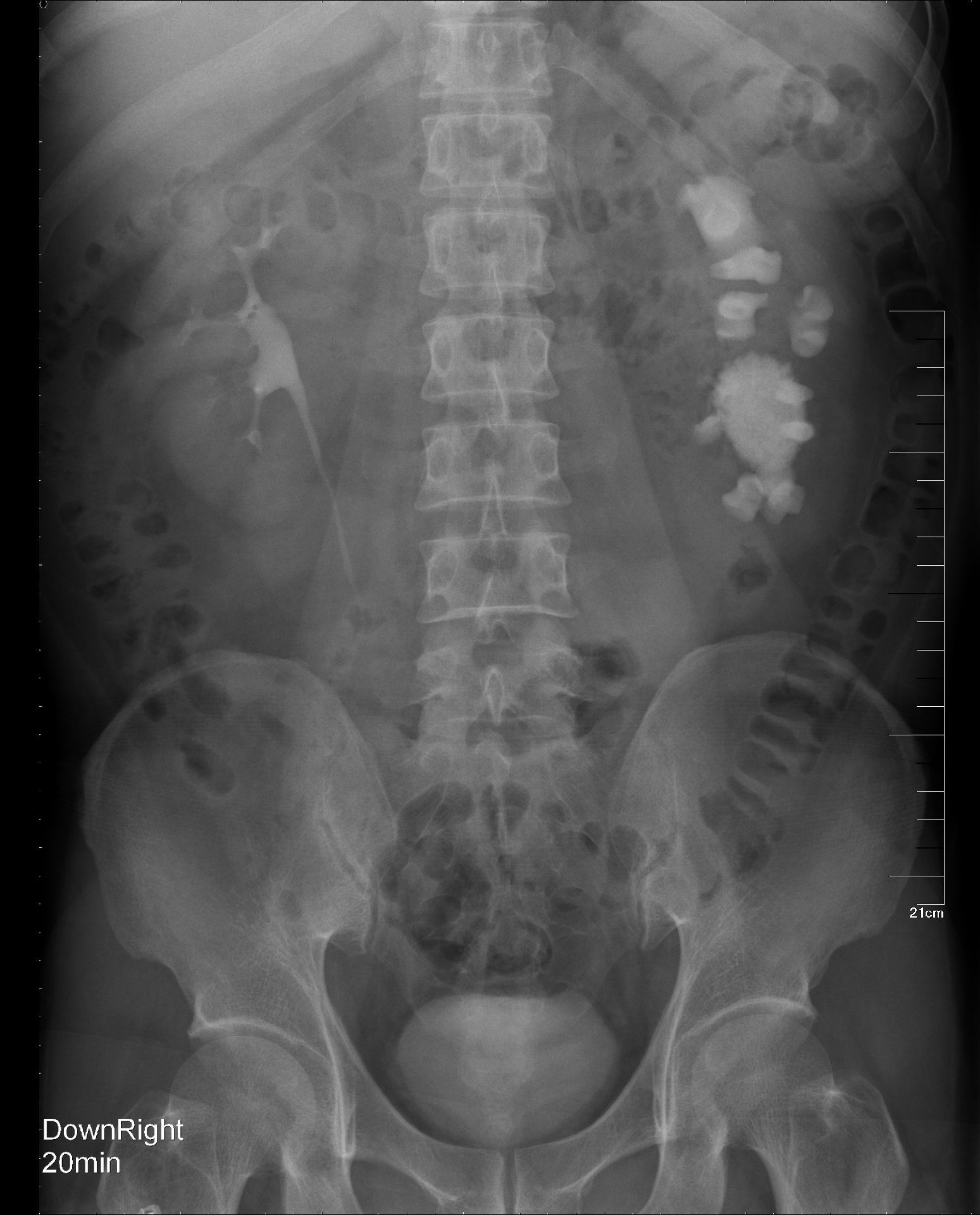 肾输尿管先天性畸形治疗的最新进展