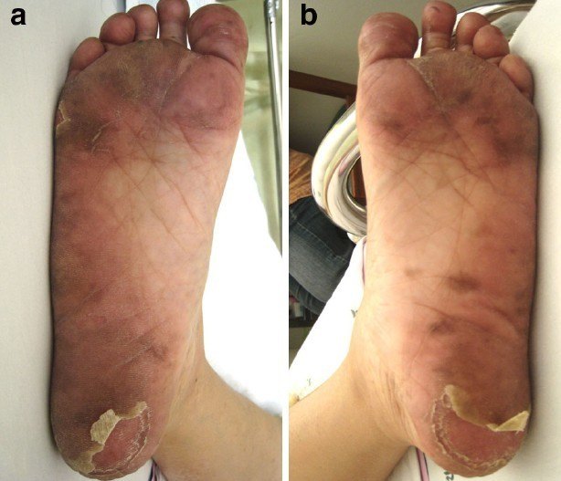 期直肠癌女性患者完成 2 个周期的卡培他滨化疗后数天发生的手足综合