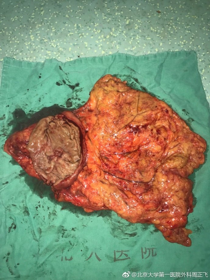 标本显示直径2.0公分溃疡型癌,溃疡面较深.