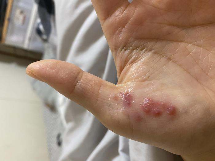 手上疱疹及同侧指甲白斑求解