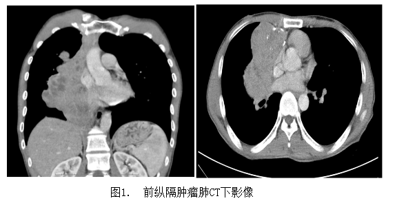 图2.切除的胸腺瘤图3.术后3年复查的肺ct