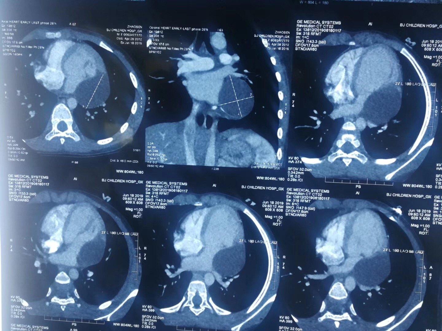 第一次开展胸腔镜下心脏囊肿切除手术