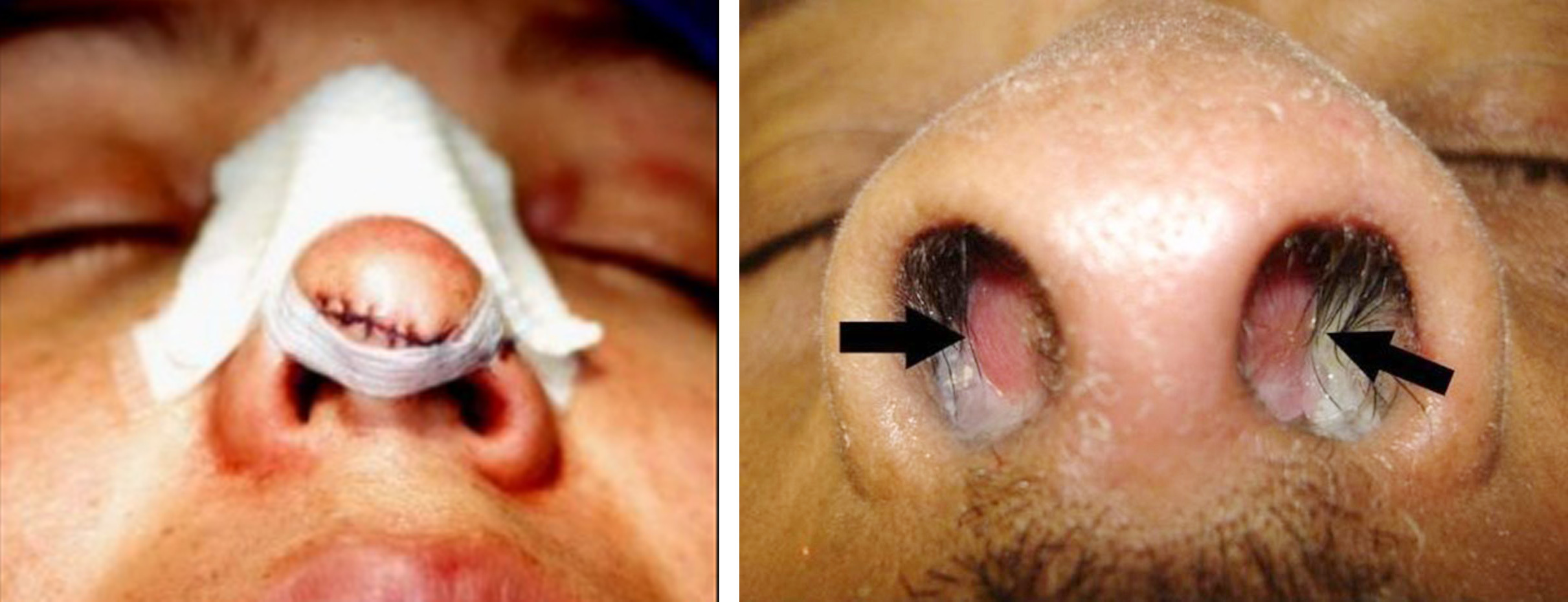 鼻子外面红红的一按就疼是啥情况