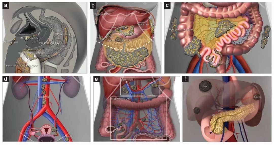 卵巢癌大网膜切除图解图片