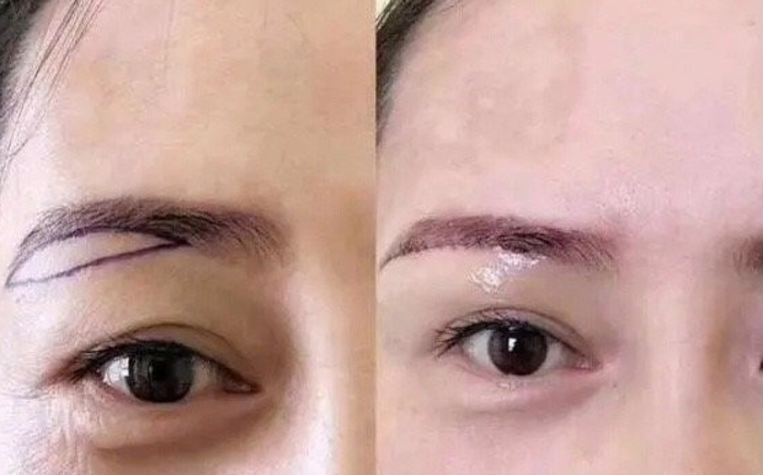 比如说:眼睑松弛严重形成了三角眼,提眉术后可以重现原本双眼皮的形态