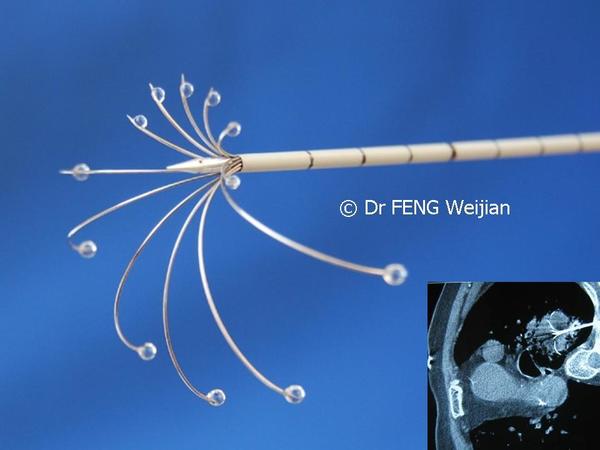 准实时ct引导与适形射频消融治疗肝癌肺癌