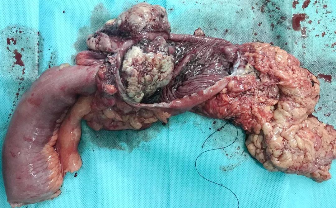 耄耋老人的生命赛跑——老年肠梗阻要警惕_方法医生文