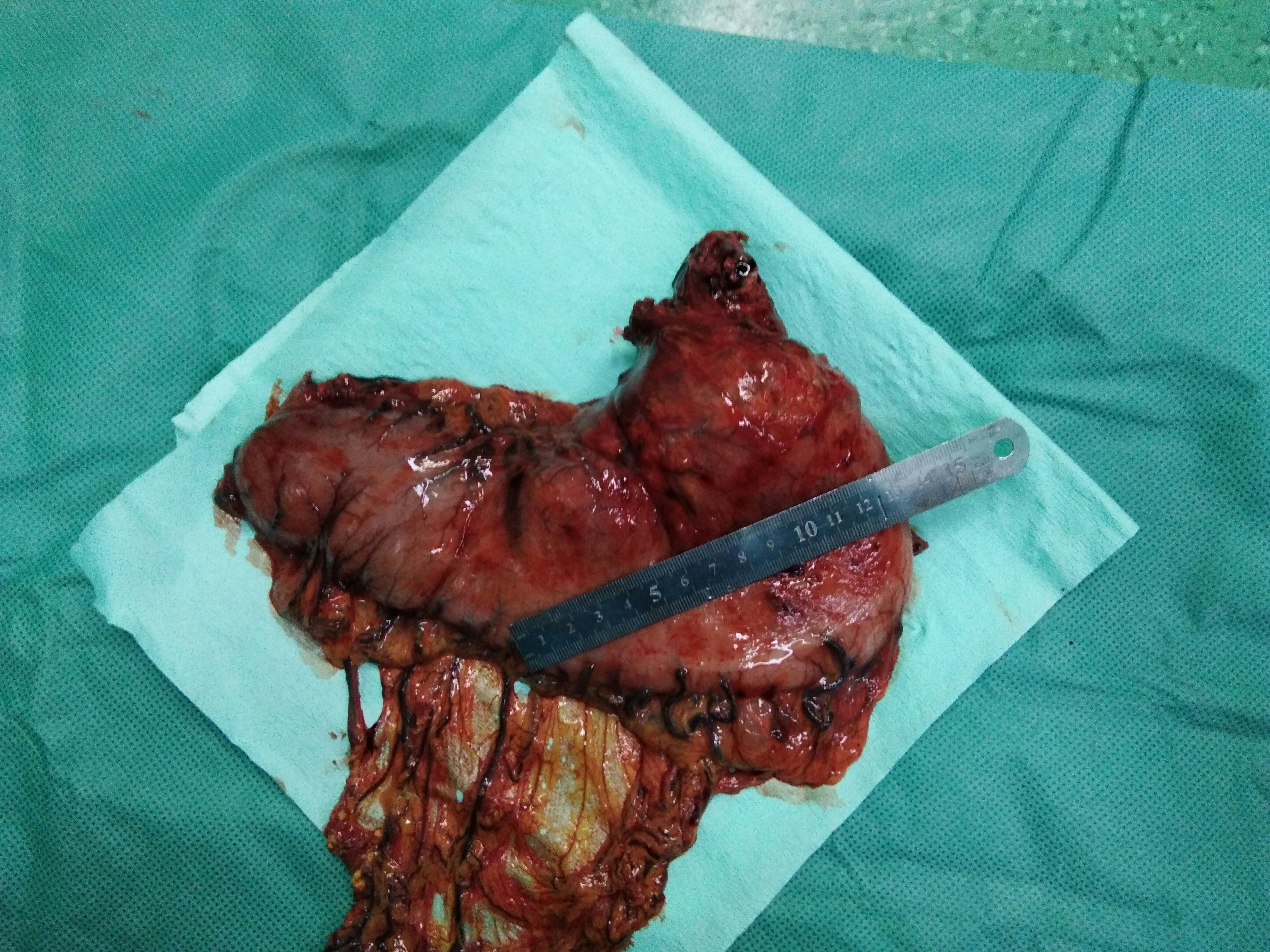 胃底贲门部腺癌更适合腹腔镜经腹及食管裂孔手术