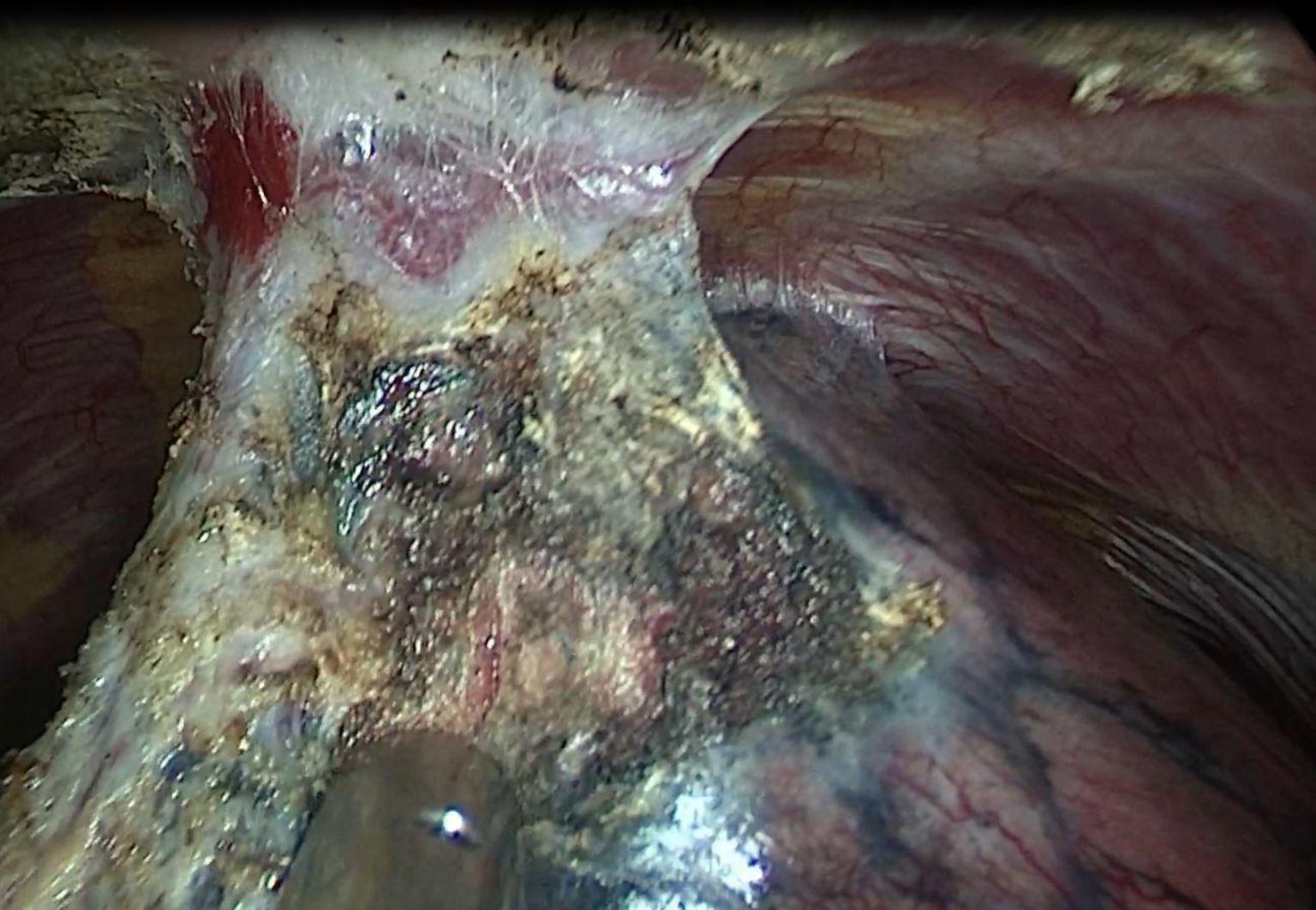 看图说肺胸膜粘连