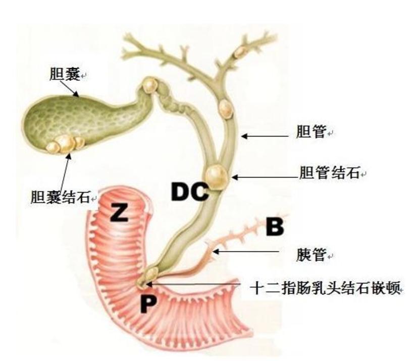 同时得了胆囊结石和胆总管结石 怎么办 健康号 微医