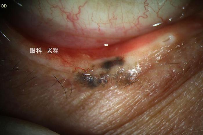 眼睑恶性肿瘤系列之基底细胞癌