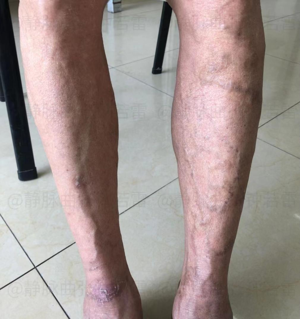 七旬老人被"老烂腿"折磨多年,老伴儿为其四处求医