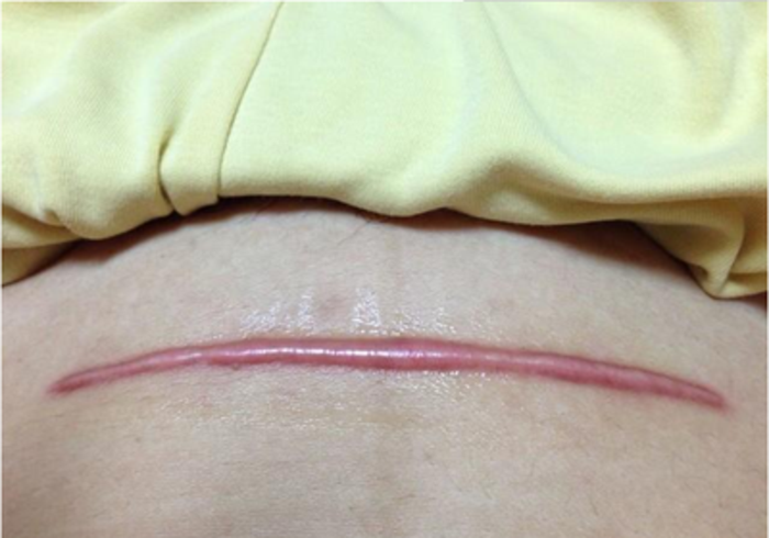 剖腹产疤痕如果增生了我们该怎么办呢