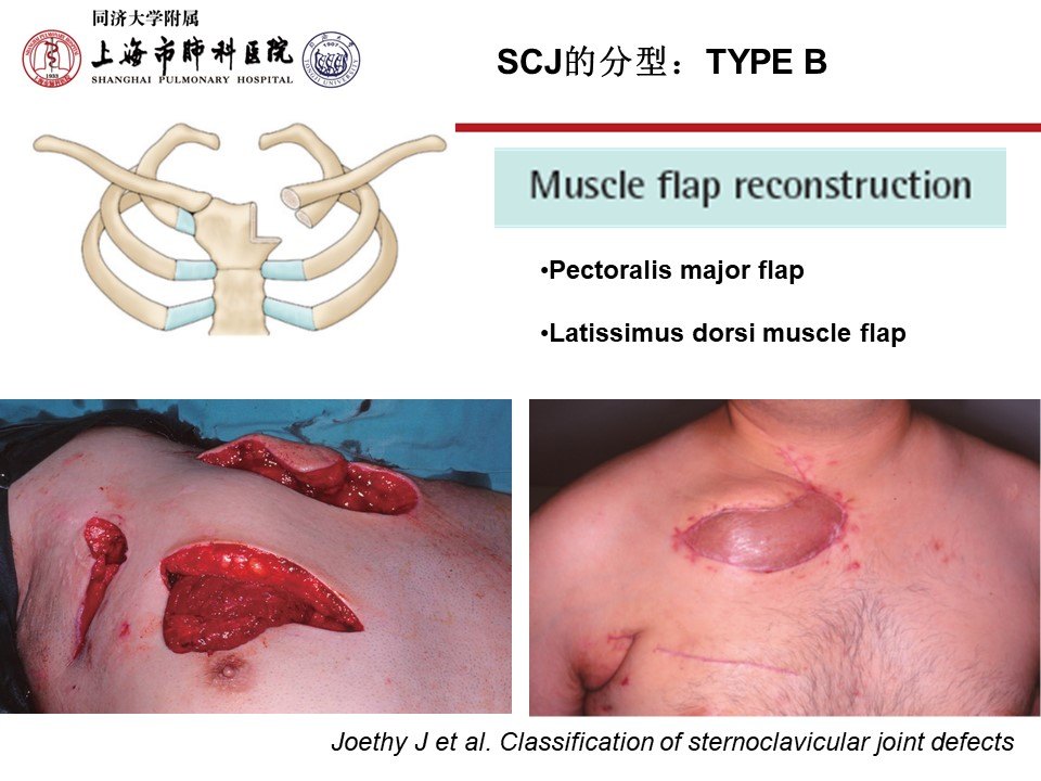 胸锁关节感染的外科治疗