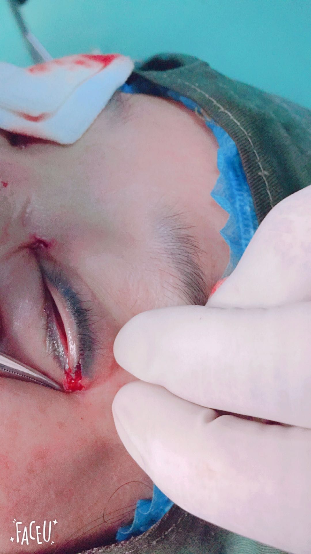 崔正军教授谈开内眼角和外眼角的体会 - 微医(挂号网)