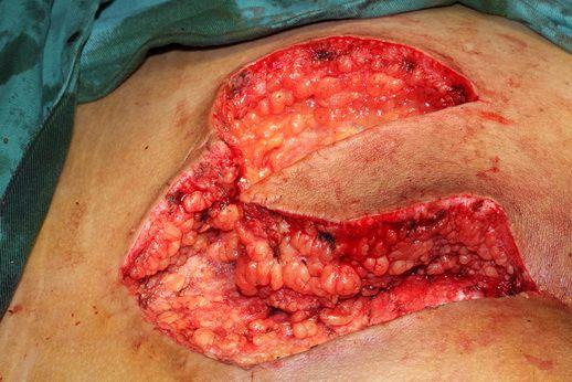 藏毛窦囊肿切除转移皮瓣成型术