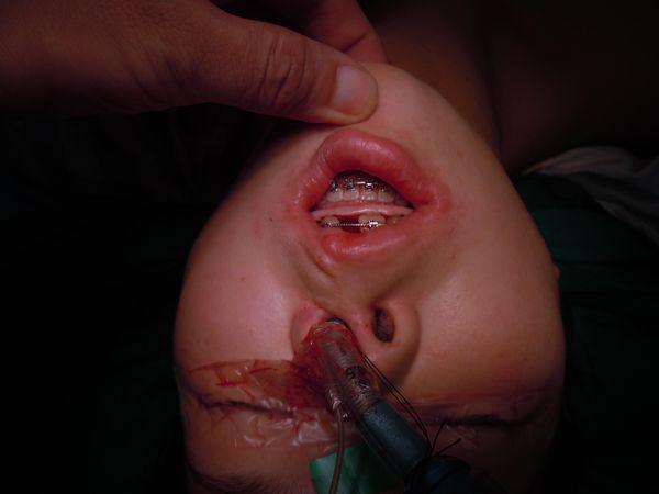 要求别太高,这已经不错了,这样手术难度低正常人难度大多了,好在没有