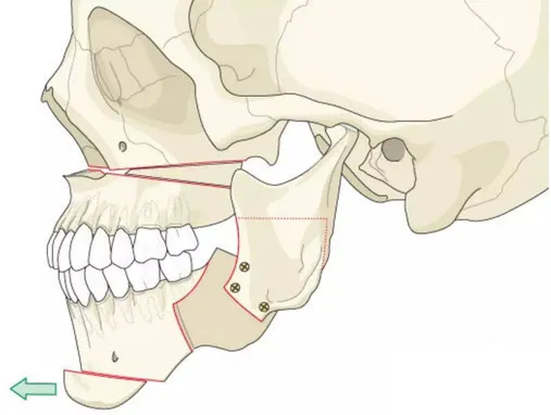 颏成型与正颌的区别是什么