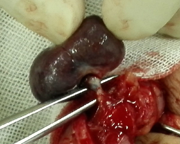 图5 睾丸扭转坏死图6  睾丸肿瘤(内胚窦瘤)当前浏览器不支持播放视频