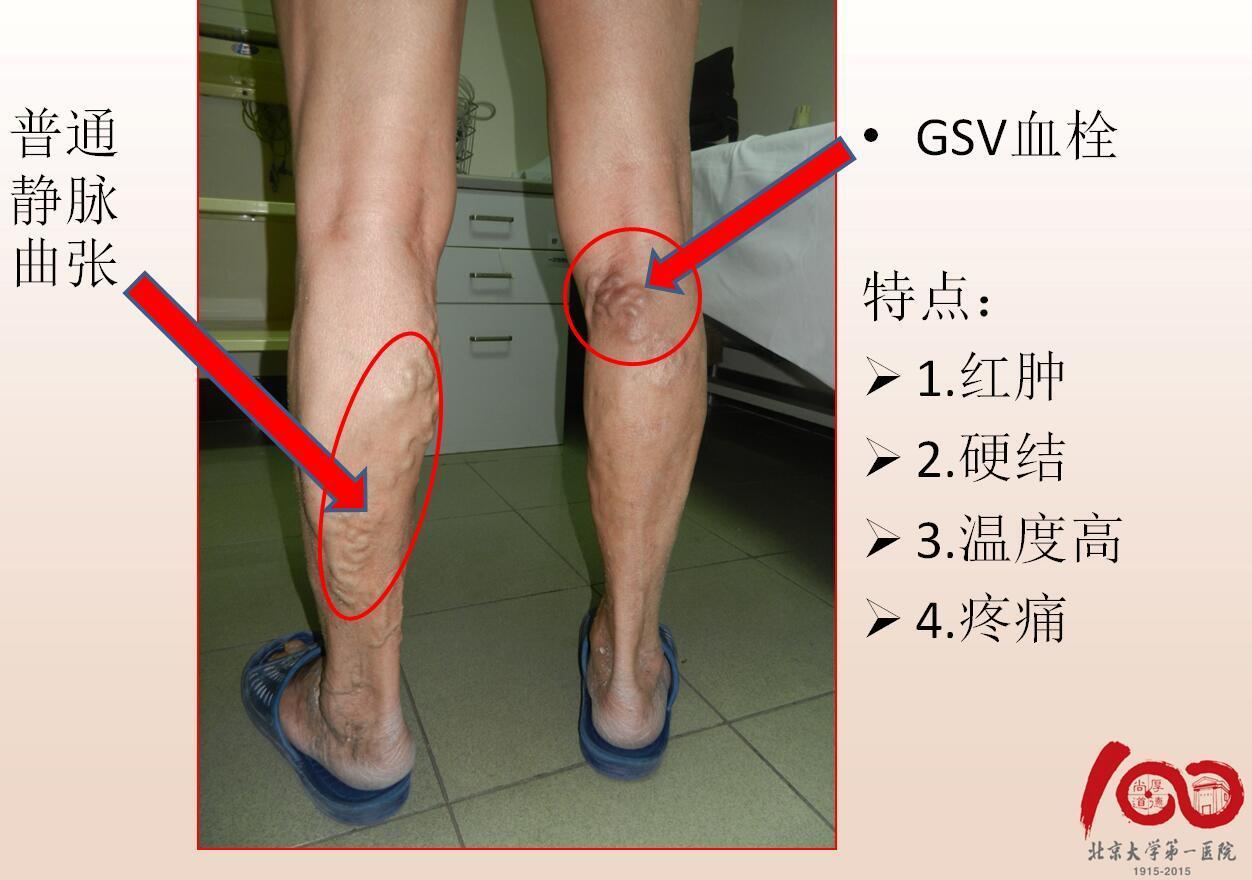 下肢静脉曲张有血栓发炎能做手术吗