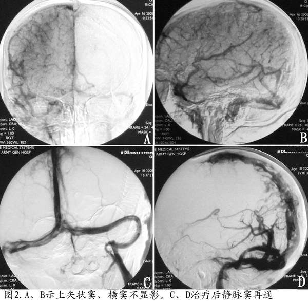 产后颅内静脉窦血栓形成介入治疗 - 微医(挂号网)