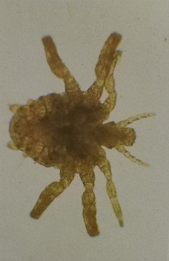 难言的外生殖器皮肤病之阴虱