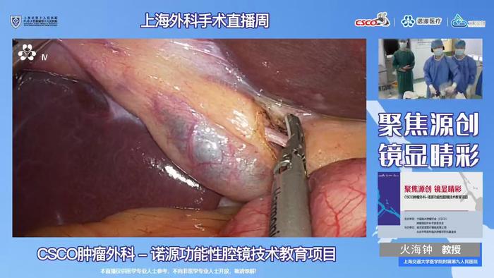 胆囊结石超微创手术单孔