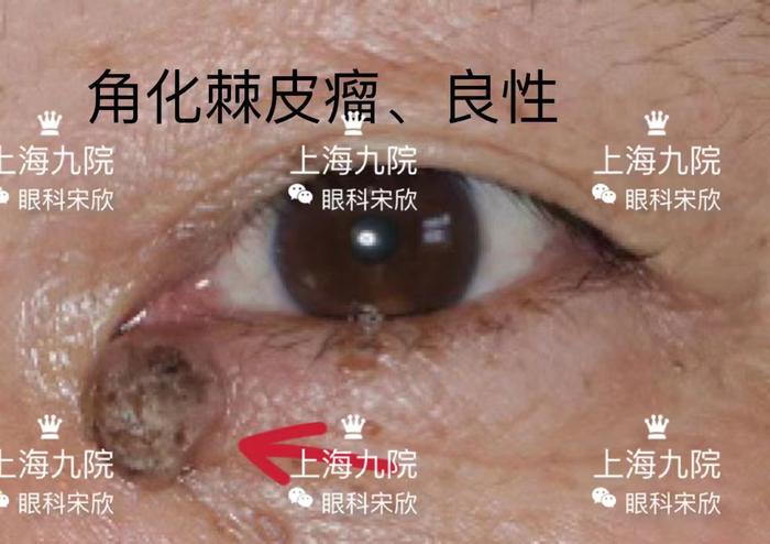 眼皮上奇奇怪怪的疙瘩都是什么常见眼睑肿瘤图片良恶性
