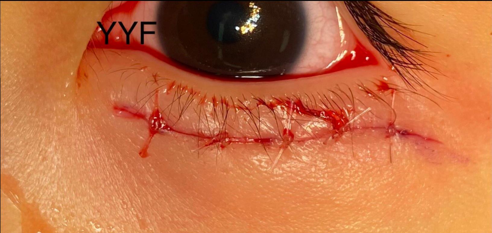 眼眶肿瘤之眼眶下方上皮性囊肿的皮肤入路切除完整摘除的重要性