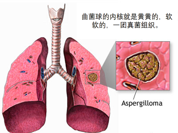 肺曲菌球是什么病严重吗要做手术吗