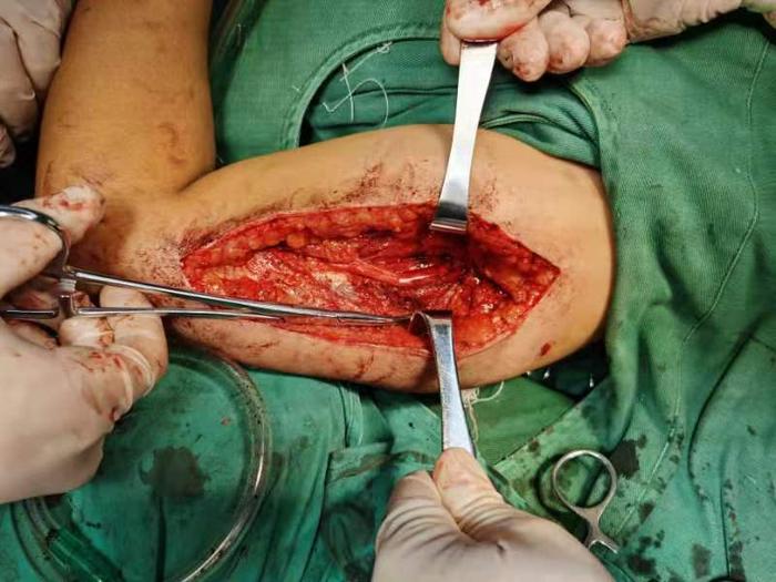 桡神经损伤 - 微医(挂号网)